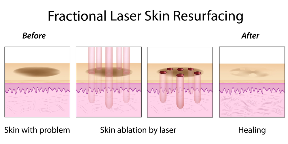 Acne Laser Treatments Information