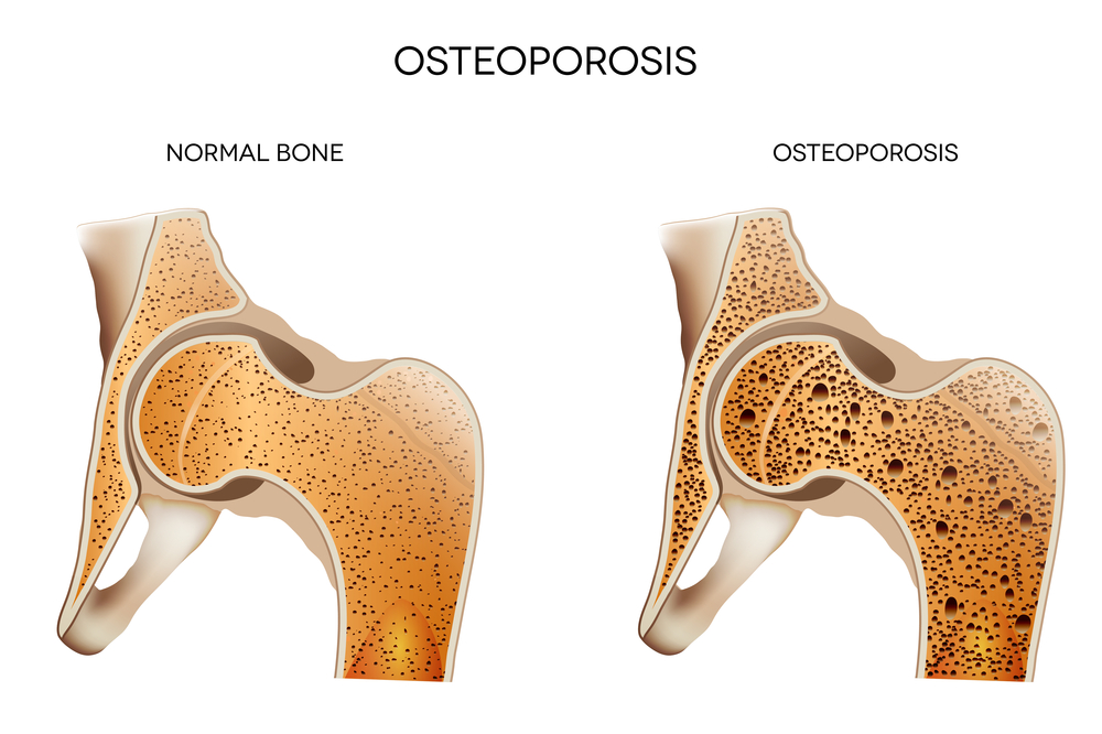 improve bone density