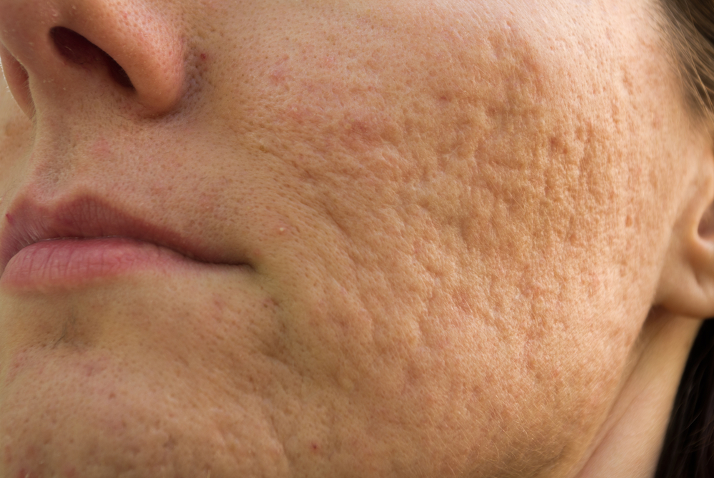 Clear Acne Scars Fast & Simple with the Best Methods
