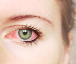 Tips to Tackle Eye Allergies