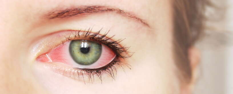 Tips to Tackle Eye Allergies