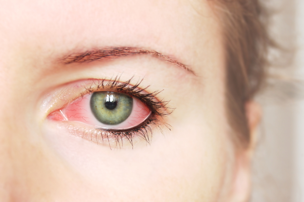 Tips to Tackle Eye Allergies