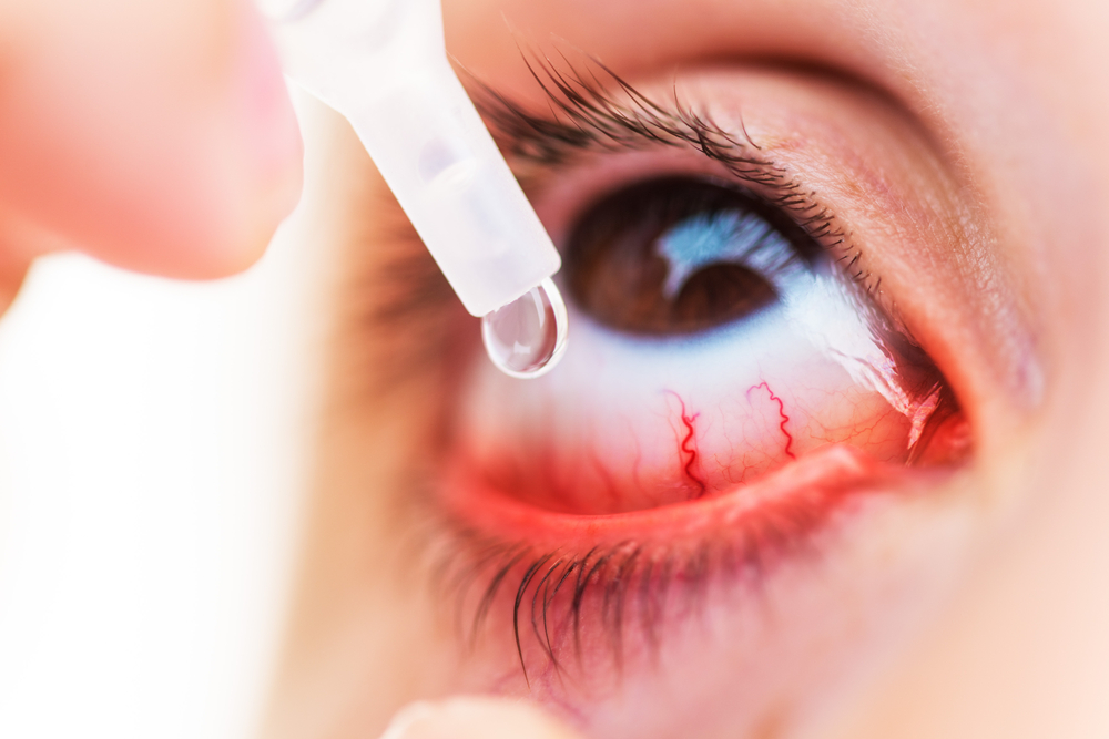 Tips to Tackle Eye Allergies