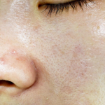 acne and oily skin