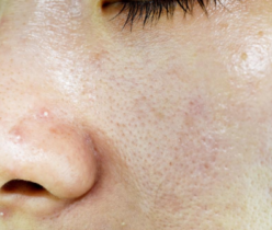 acne and oily skin