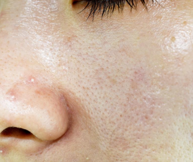 acne and oily skin