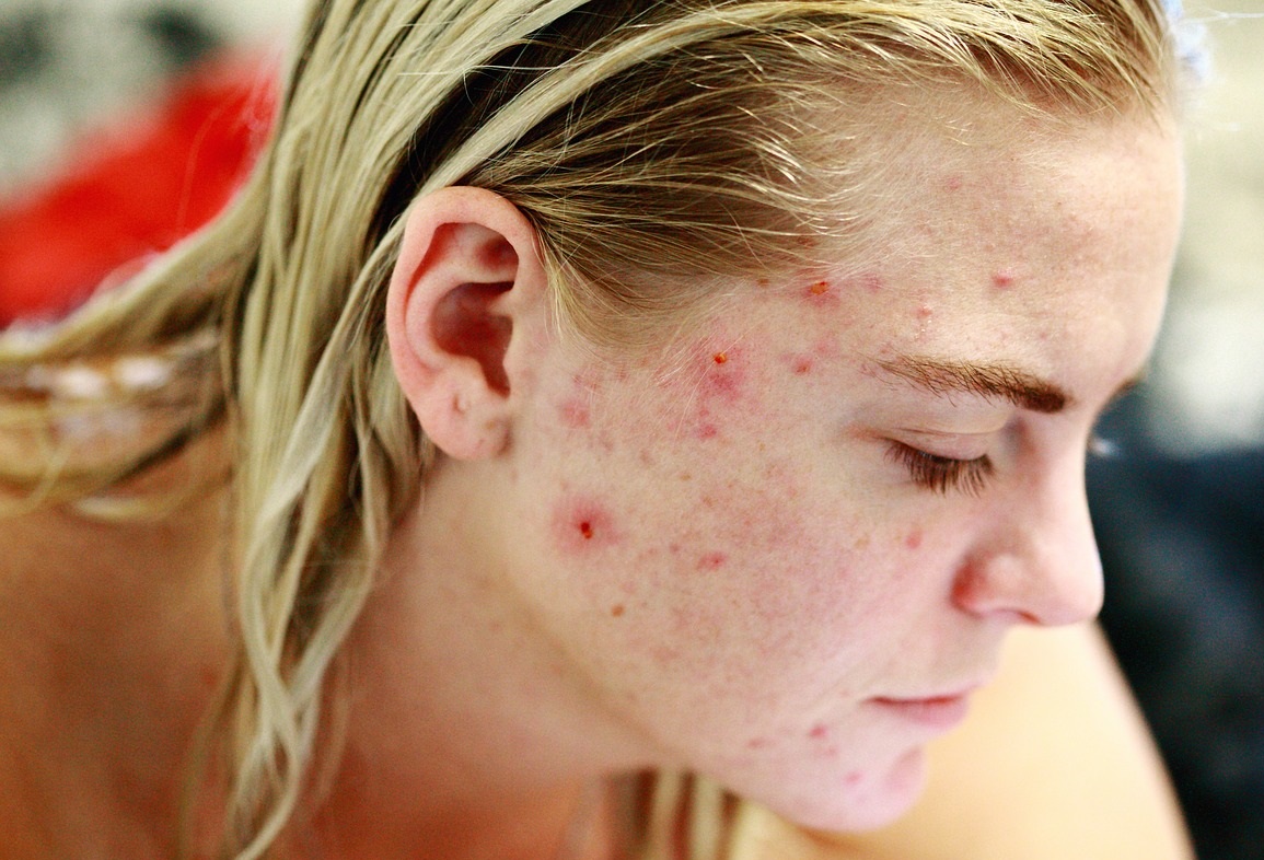 acne dos and donts ( A ret gel)_Banner
