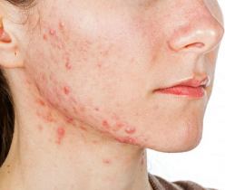 Do's & Don'ts of Fighting Acne