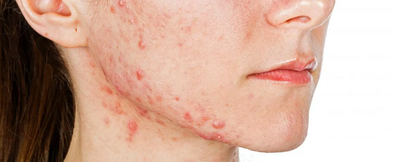 Do's & Don'ts of Fighting Acne