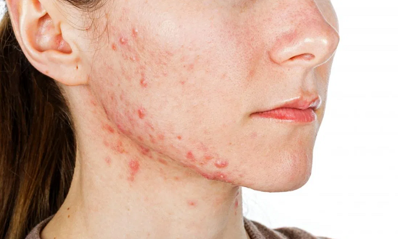 Do's & Don'ts of Fighting Acne