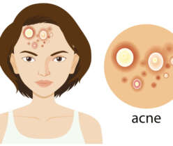 acne