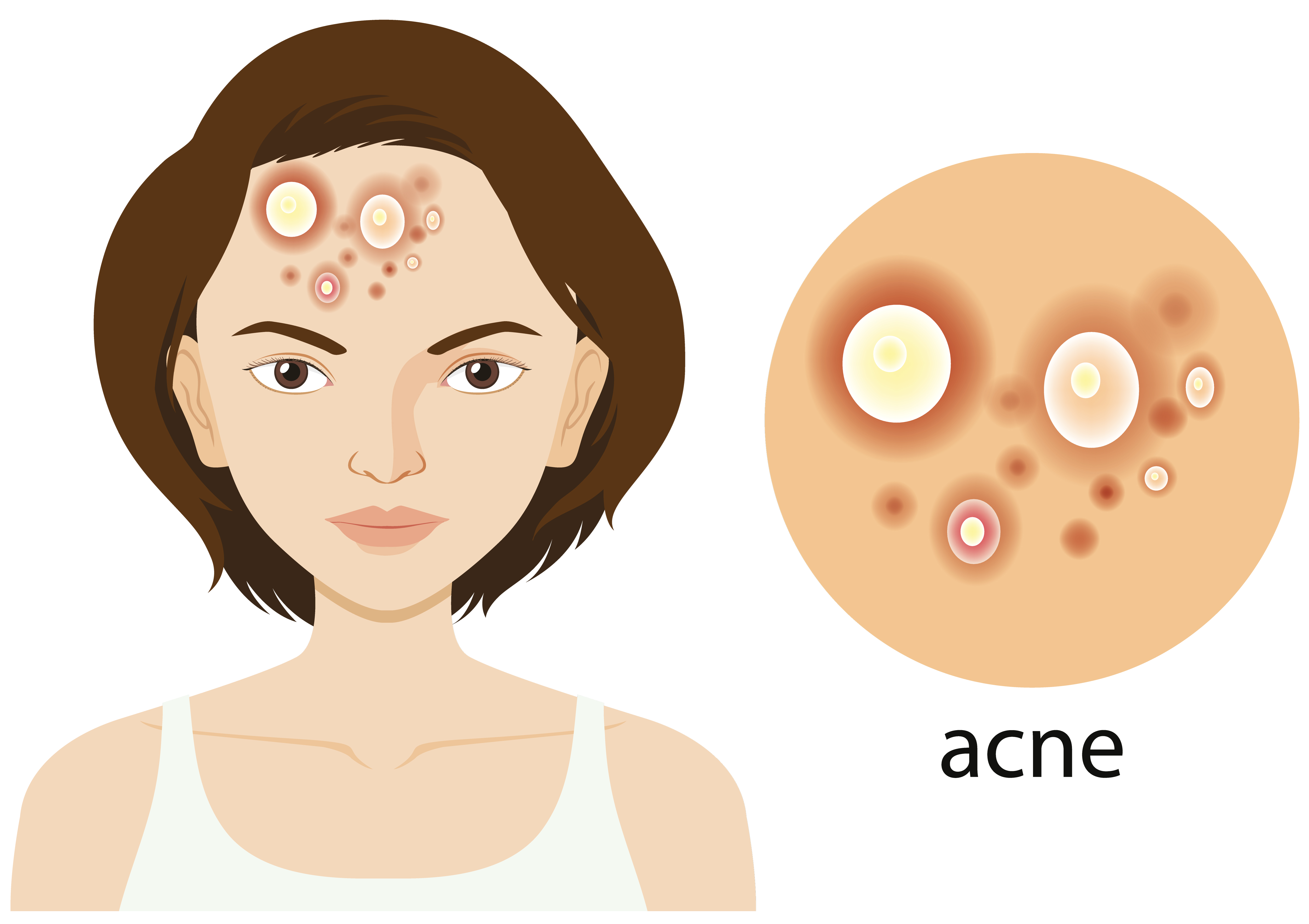 Are Acne And Pimple Is The Same Thing Reliablerxpharmacy Blog