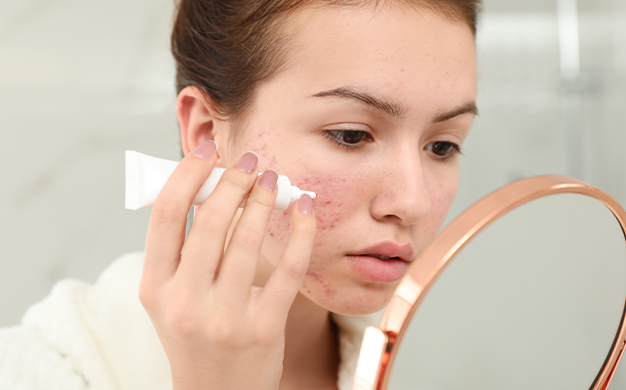 Different Kinds Of Acne & How To Treat Them