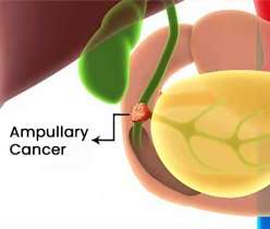 Ampullary Cancer