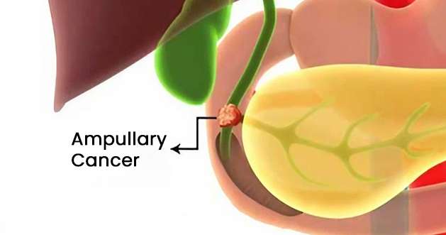 Ampullary Cancer