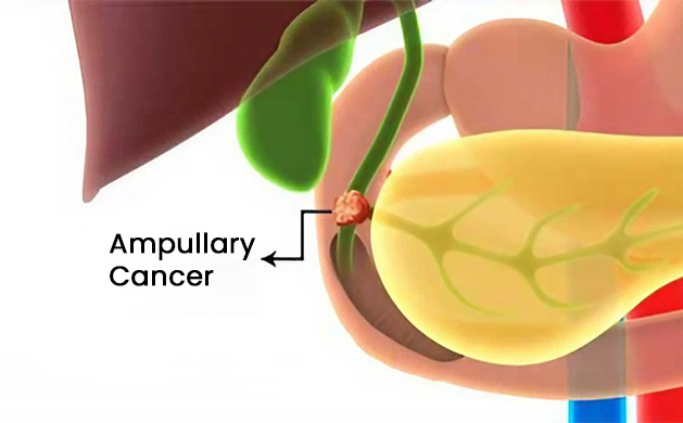 Ampullary Cancer