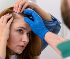 PCOS and Hair Loss: How To Manage
