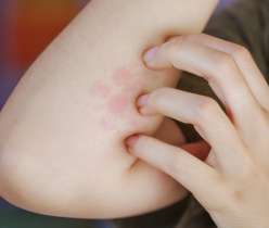 How Fungal Infections Affect Immunity