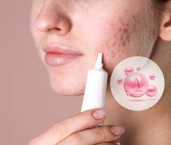 Woman applying Retino A generic cream to acne-affected skin, highlighting the benefits of Vitamin A for clearer skin