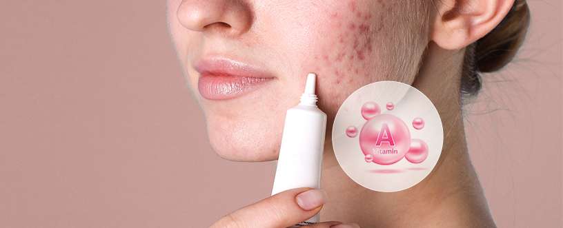 Woman applying Retino A generic cream to acne-affected skin, highlighting the benefits of Vitamin A for clearer skin