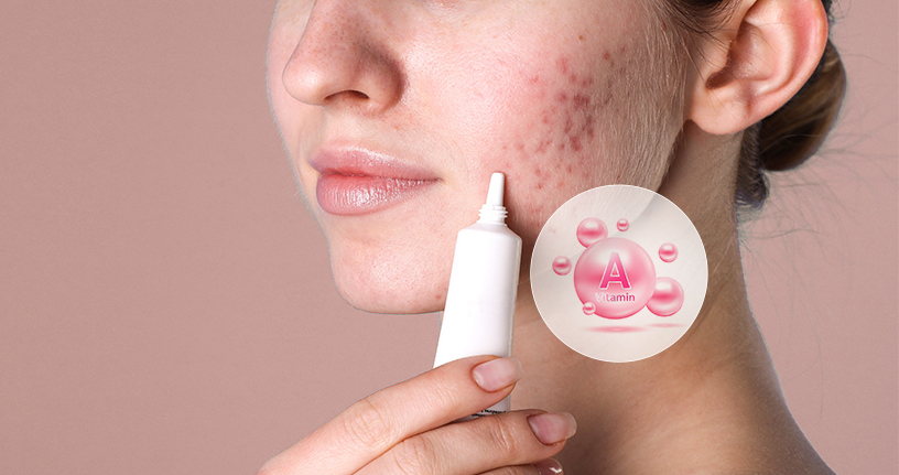 Woman applying Retino A generic cream to acne-affected skin, highlighting the benefits of Vitamin A for clearer skin