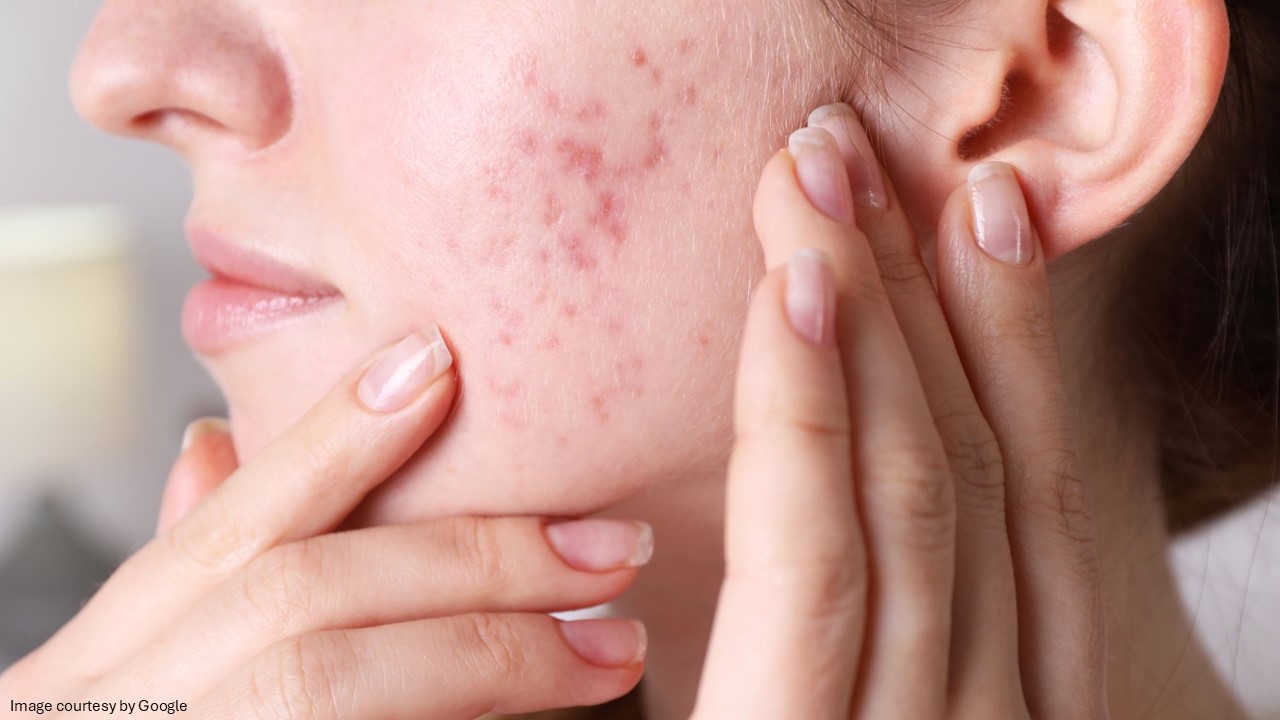 Benzoyl Peroxide for Acne 