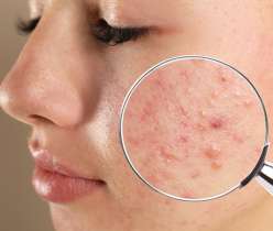 Differin Gel or Benzoyl Peroxide for Acne