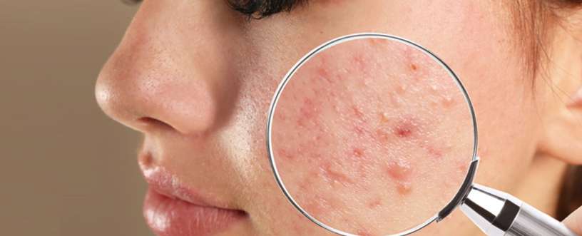 Differin Gel or Benzoyl Peroxide for Acne