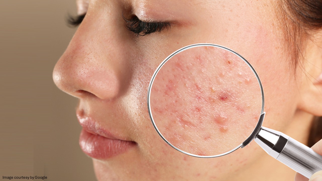 Differin Gel or Benzoyl Peroxide for Acne