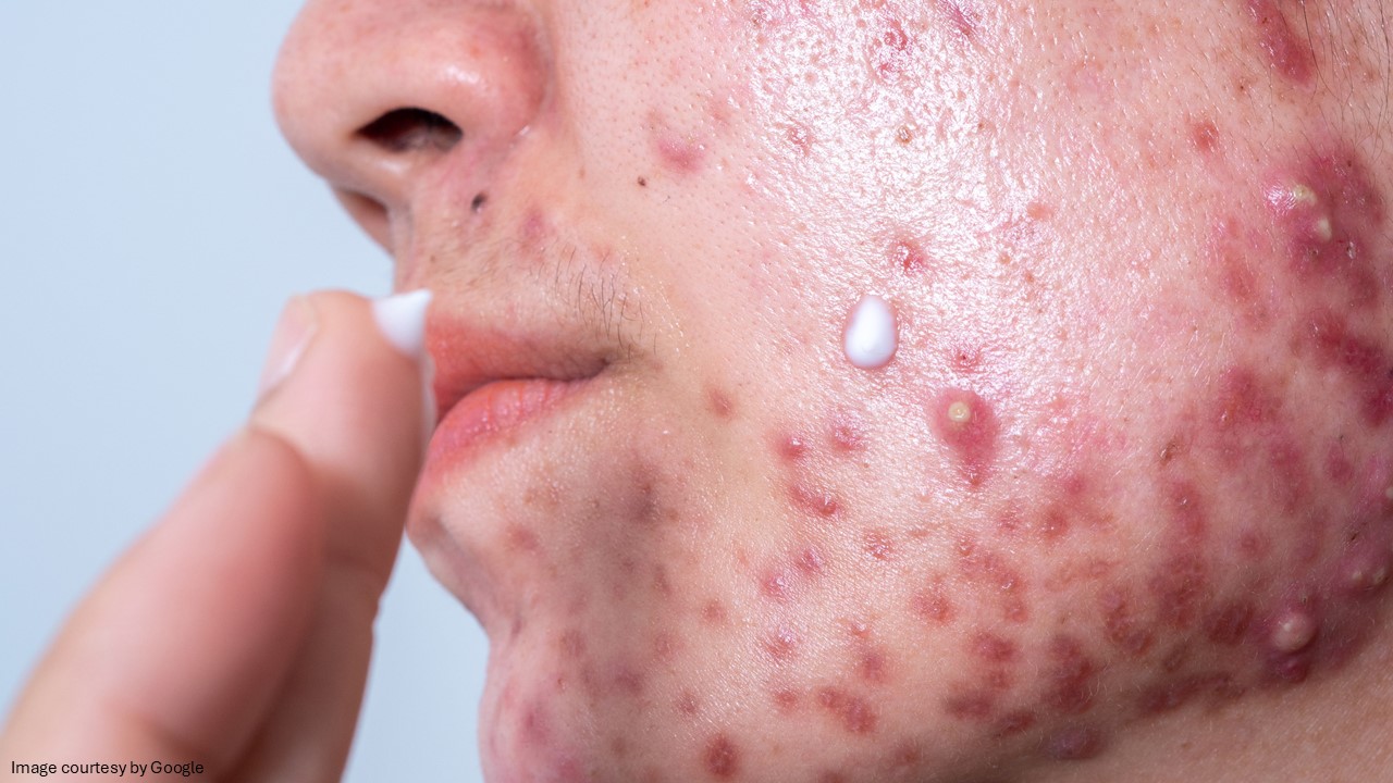 what to expect with tretinoin 