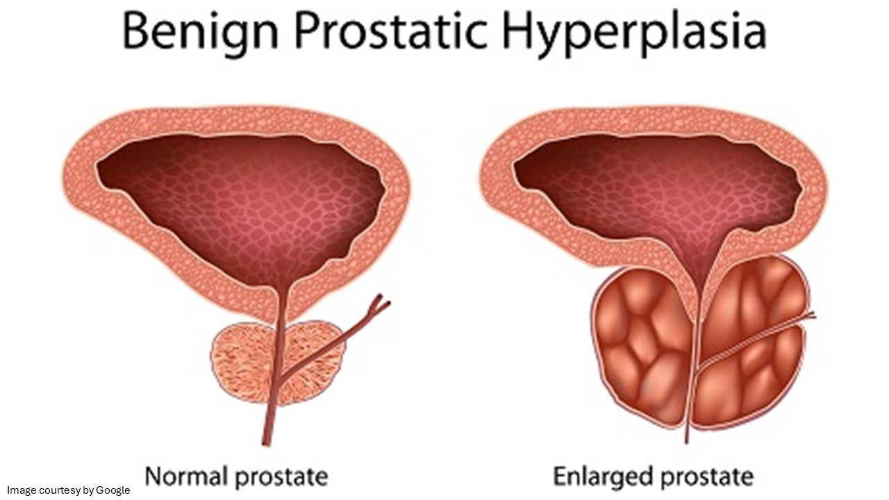 early signs of bladder prostate