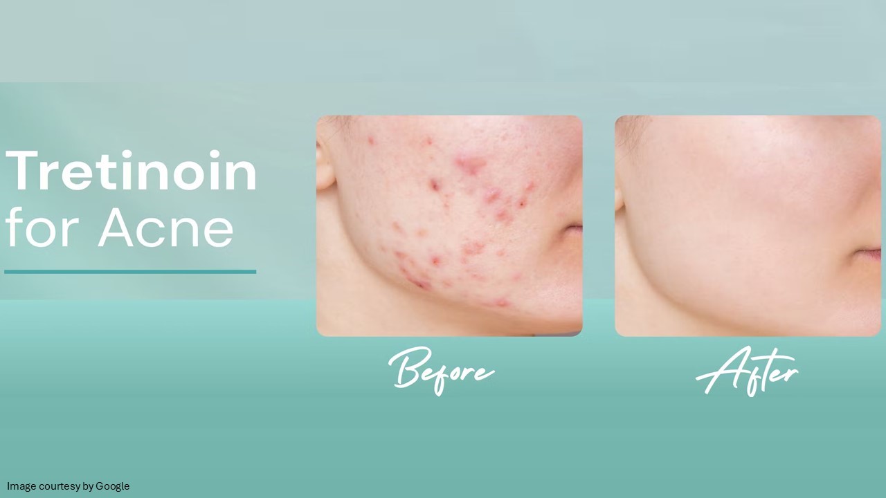 tretinoin for acne
