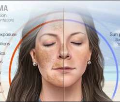 how to use triluma cream
