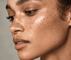 A girls face with melasma