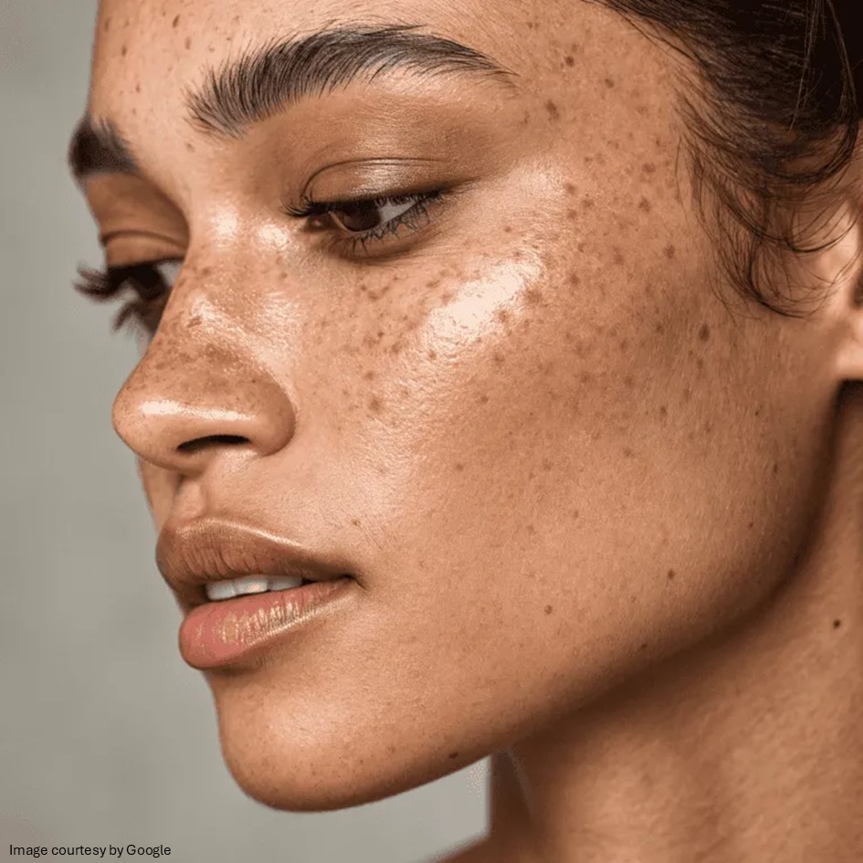 A girls face with melasma