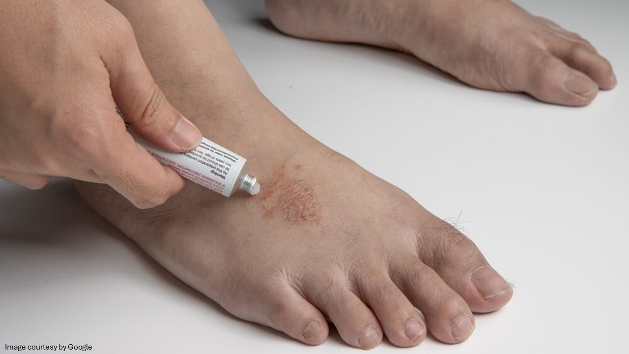 A hand applying anti fungal cream on leg