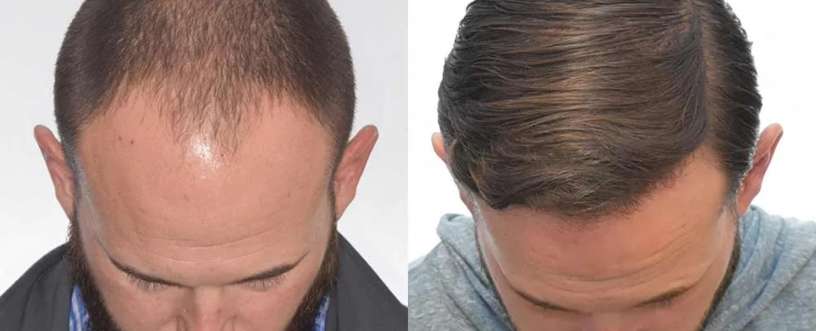 Before and after of Hair Transplants