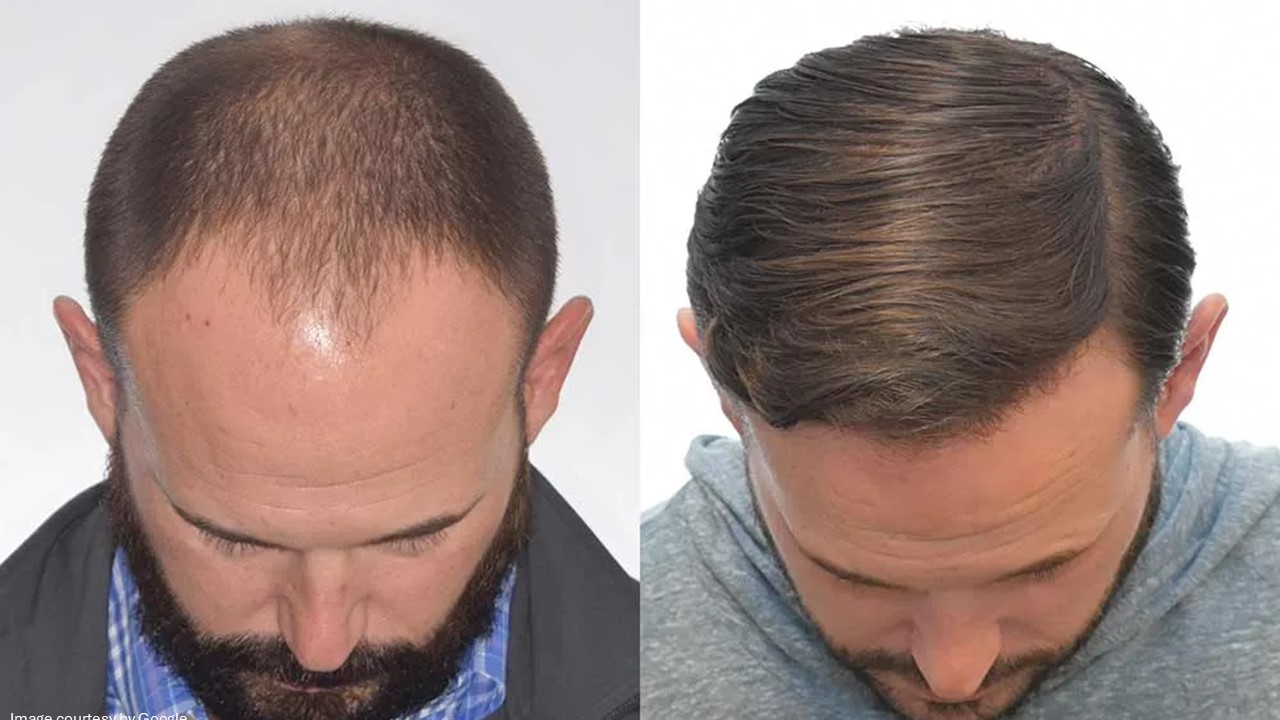 Before and after of Hair Transplants