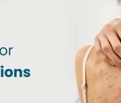 Best cream for antifungal