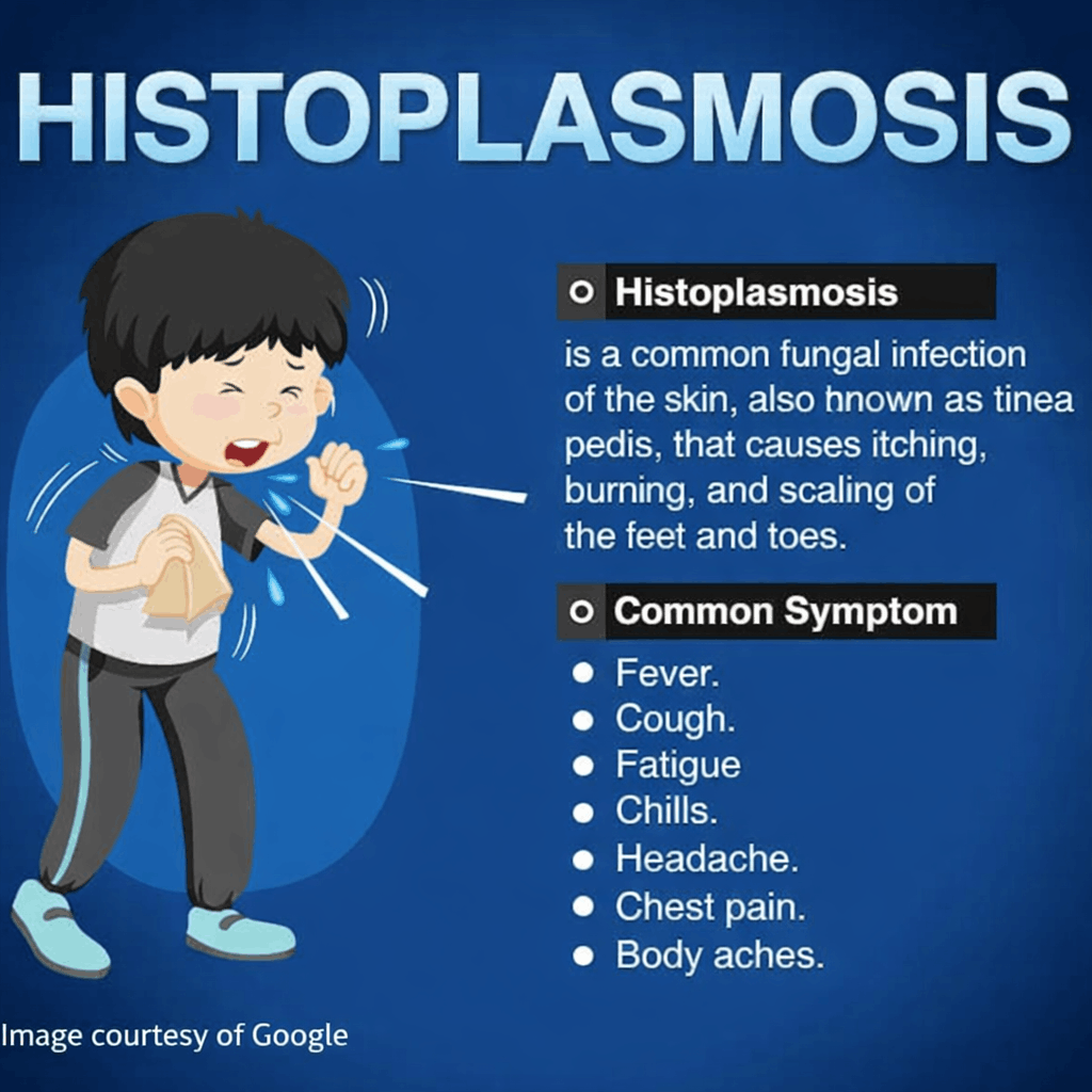 Symptoms of Histoplasmosis