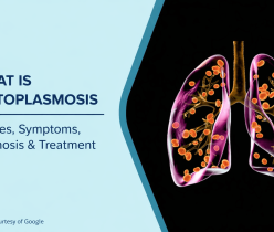 What is Histoplasmosis
