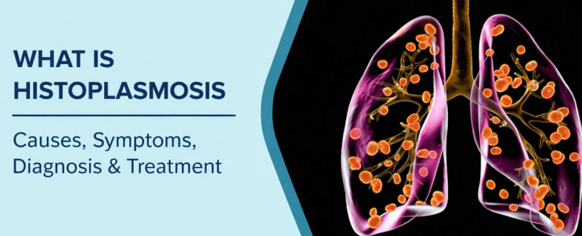What is Histoplasmosis