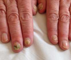 Fungal nail infection