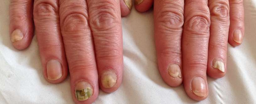 Fungal nail infection