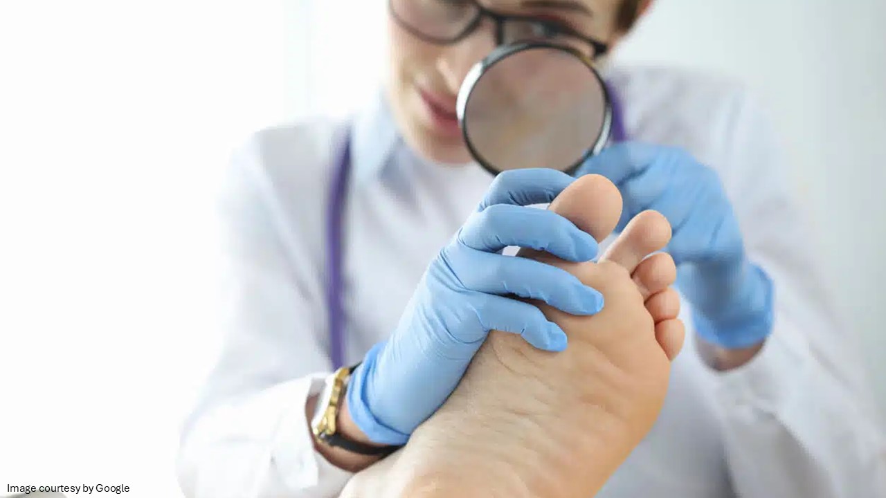 Fungal nail infection check by doctor