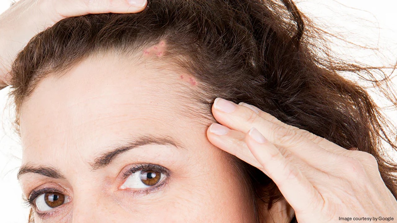 Scalp acne on women