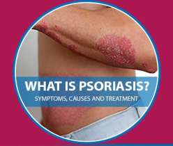 What is Plaque Psoriasis