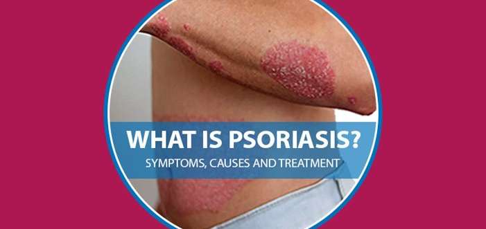 What is Plaque Psoriasis