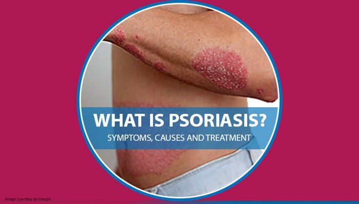 What is Plaque Psoriasis