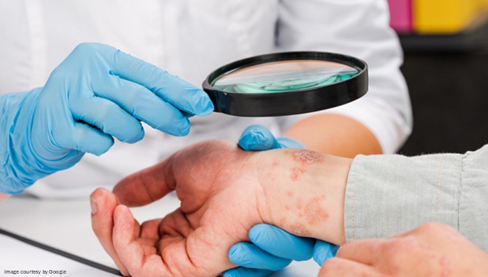 Plaque Psoriasis diagnosis